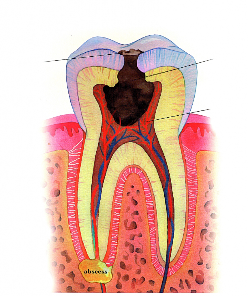 Bojājums skāris zoba kameru (pulpu), izraisot iekaisumu, sāpes un vēlāk sastrutojumu (abscesu)