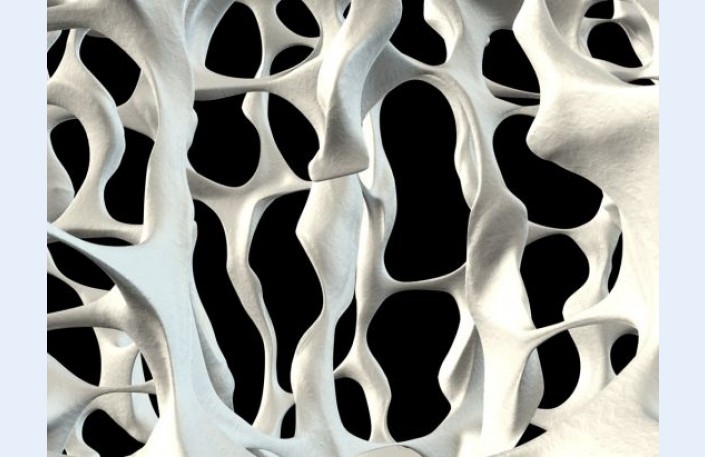 Osteoporozes sapostīts kauls. 
Autors: no www.bonesupport.com