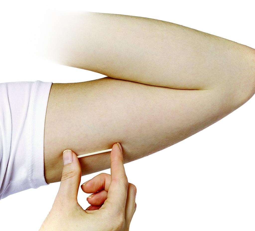 Zemādas implants 
ir četrus centimetrus garš implants, ko ārsts ievada zem ādas augšdelma iekšpusē.
Autors: mariestopes.org.za